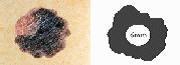 Mole (birthmarks) appearance - Diameter
