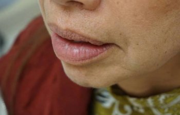 female patient after laser treatment for lip vein