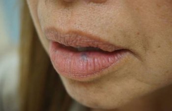 female patient before laser treatment for lip vein