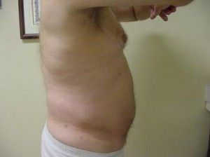 Patient After Liposuction