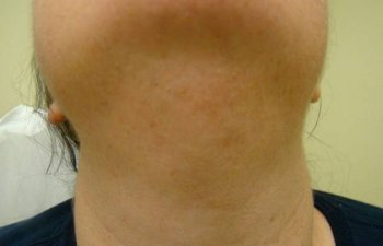 female patient after chin hair laser removal