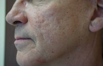 middle-aged male patient with acne scarring after Bellafill treatment