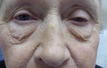 female patient before blepharoplasty