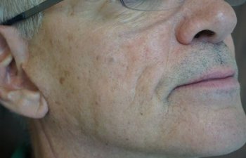 middle-aged male patient with acne scarring before Bellafill treatment