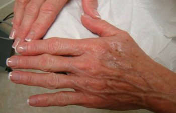 hands before Radiesse treatment