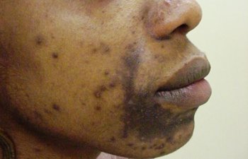 patient before chemical peel