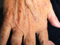 hands after Radiesse treatment