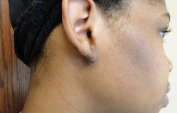 female patient after ear keloid treatment