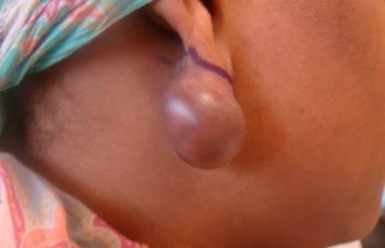 female patient before ear keloid treatment