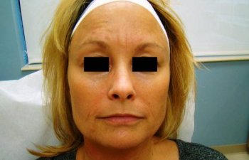 female patient before Restylane treatment for frown lines