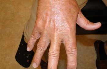 hand after IPL laser treatment