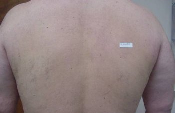 male patient after back hair laser removal