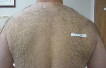 male patient before back hair laser removal