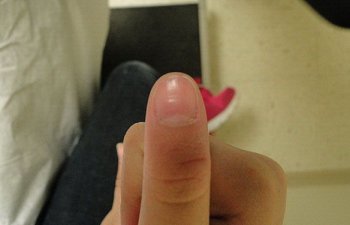 finger after laser wart treatment