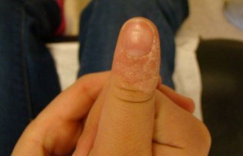 finger before laser wart treatment