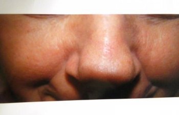 patient after laser treatment for nose vein