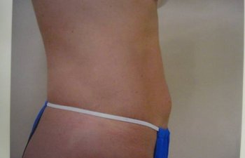 female patient after tumescent liposuction
