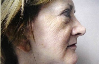 patient before chemical peel