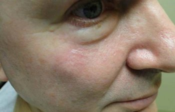 patient after lower eyelid Mohs surgery
