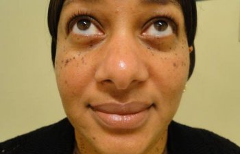 female patient before mole removal