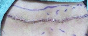 skin with stitches after surgical tattoo removal
