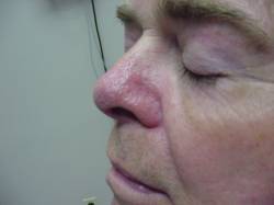 male patient after laser treatment for nose spider vein