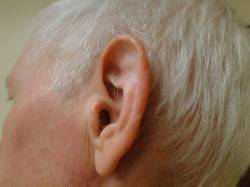 patient after ear Mohs surgery