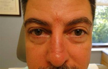 male patient after nose Mohs surgery