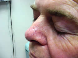 male patient before laser treatment for nose spider vein