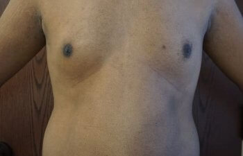 Patient Before Beautiful 360 Laser Liposuction