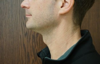 Kybella before and after.