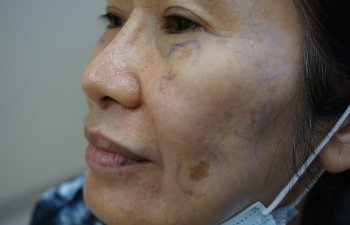 Female Patient Before Pico Genesis Laser Procedure