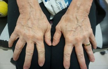 hands before Radiesse procedure