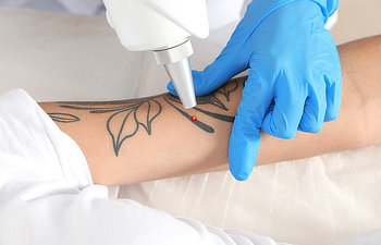 woman undergoing laser tattoo removal procedure in salon